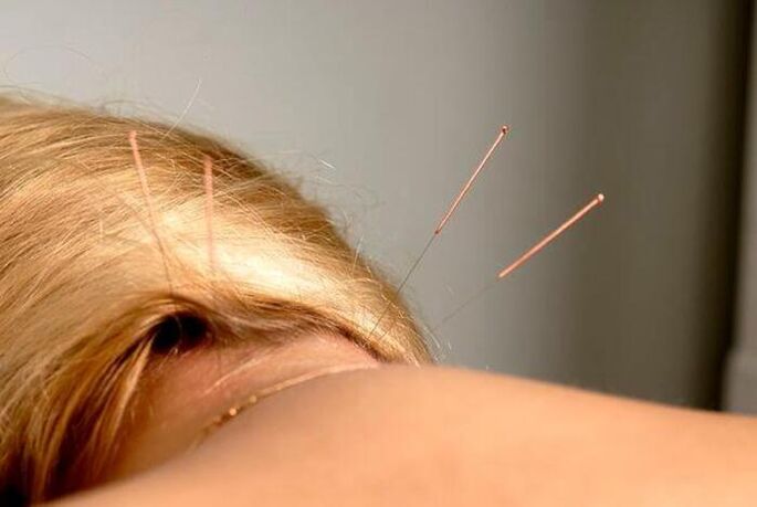 acupuncture pour ostéochondrose