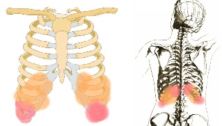 le mal de dos sous les côtes des symptômes