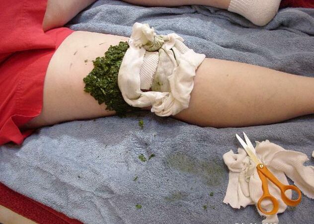 Une compresse chaude de feuilles de chou broyées sur une articulation douloureuse du genou avec arthrose